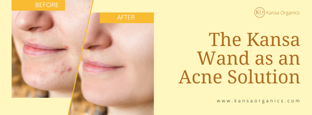 The Kansa Wand as an Acne Solution